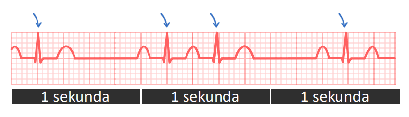 ekg: Određivanje frekvence kod nepravilnog ritma