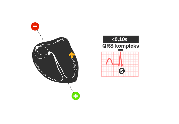 ekg: depolarizacija komora, QRS kompleks
