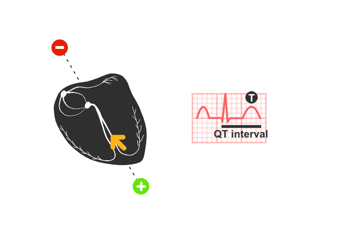 ekg: repolarizacija komora