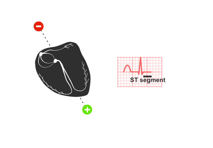 ekg: ST segment