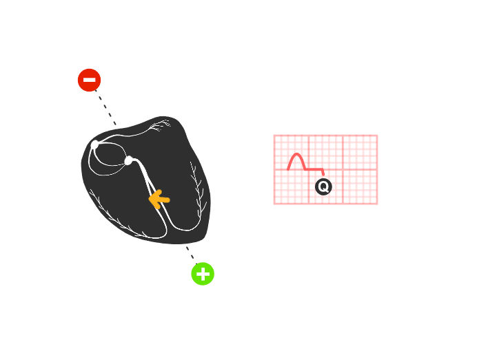 ekg: Depolarizacija septuma i Q talas